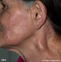 leprosy tuberculoid