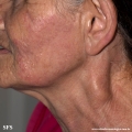 leprosy tuberculoid