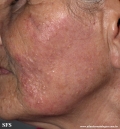 leprosy tuberculoid