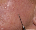 leprosy tuberculoid