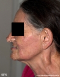 leprosy tuberculoid
