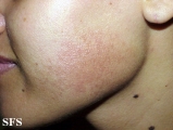 erythromelanosis follicularis of the face