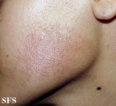 erythromelanosis follicularis of the face