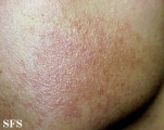 erythromelanosis follicularis of the face