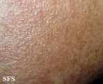 erythromelanosis follicularis of the face