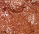 pityriasis rubra pilaris
