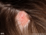 aplasia cutis congenita
