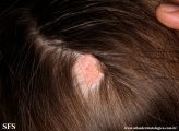 aplasia cutis congenita