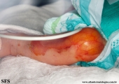 aplasia cutis congenita