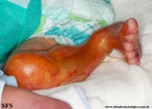 aplasia cutis congenita