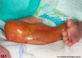 aplasia cutis congenita
