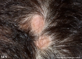 aplasia cutis congenita