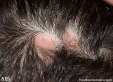 aplasia cutis congenita