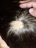 aplasia cutis congenita