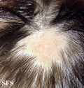 aplasia cutis congenita
