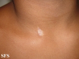 aplasia cutis congenita