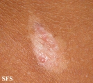 aplasia cutis congenita