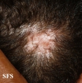 aplasia cutis congenita