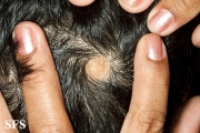 aplasia cutis congenita