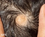 aplasia cutis congenita