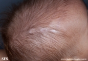 aplasia cutis congenita