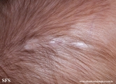 aplasia cutis congenita