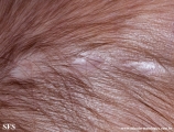 aplasia cutis congenita