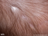 aplasia cutis congenita
