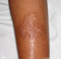 asteatotic dermatitis