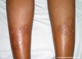 asteatotic dermatitis