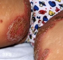 impetigo herpertiformis