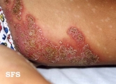 impetigo herpertiformis