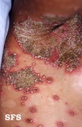 impetigo herpertiformis