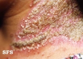 impetigo herpertiformis