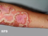 impetigo herpertiformis