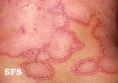 impetigo herpertiformis
