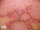 impetigo herpertiformis