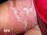 impetigo herpertiformis