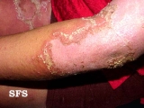 impetigo herpertiformis