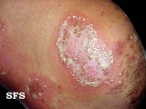 impetigo herpertiformis