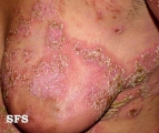 impetigo herpertiformis