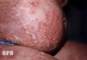 impetigo herpertiformis