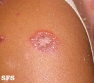 impetigo herpertiformis
