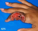 sarcoma-epithelioid sarcoma
