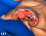 sarcoma-epithelioid sarcoma