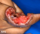 sarcoma-epithelioid sarcoma