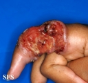 sarcoma-epithelioid sarcoma