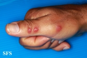rosai-dorfman disease