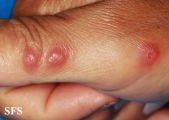 rosai-dorfman disease