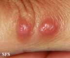 rosai-dorfman disease